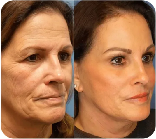 🎄🔥 Christmas Sale: Instant Face Tightener No-Filter Primer – 87% OFF! 🎅 Last Day Discount at the Official Brand Store! ✨